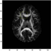 A Closed-Form Method for Improving Inter-Subject Coherence in Diffusion Tensor Magnetic Resonance Imaging