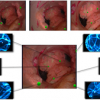 Optical Biopsy Mapping for Minimally Invasive Cancer Screening.