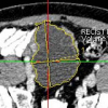 3D general lesion segmentation in CT