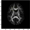 A Closed-Form Method for Improving Inter-Subject Coherence in Diffusion Tensor Magnetic Resonance Imaging