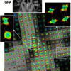 A fast and robust ODF estimation algorithm in Q-ball imaging