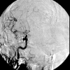 A Fast Image Registration Technique for Motion Artifact Reduction in DSA