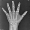 A fully automatic algorithm for contour detection of bones in hand radiographs using active contours