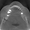 A practical method to reducing metal artifact for dental CT scanners