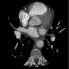 Analysis and mitigation of calcium artifacts in cardiac multidetector CT