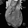 Automatic heart isolation for CT coronary visualization using graph-cuts