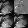 Exact correction of sharply varying off-resonance effects in spiral MRI