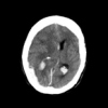 Hemorrhage slices detection in brain CT images