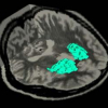 Improving MMI with Enhanced-FCM for the Fusion of Brain MR and SPECT Images