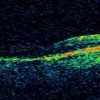 Local quality assessment for optical coherence tomography