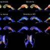 Mapping ventricular changes related to dementia and mild cognitive impairment in a large community-based cohort