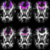 Modelling Noise-Induced Fibre-Orientation Error in Diffusion-Tensor MRI