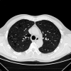 Recognizing Emphysema- A Neural Network Approach