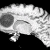 Registration of brain images with tumors: towards the construction of statistical atlases for therapy planning