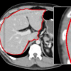 Removal Of Abdominal Wall For 3d Visualization And Segmentation Of Organs In Ct Volume