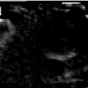 Robust statistical registration of 3D ultrasound images using texture information