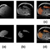 Semiautomatic non-rigid 3-D image registration for MR-Guided Liver Cancer Surgery