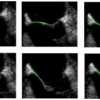 Tracking of the mitral valve leaflet in echocardiography images