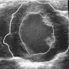Ultrasound Myocardial Tracking with Speckle Reducing Anisotropic Diffusion Assisted Initialization