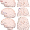 Using surface normals to localize subdural intracranial electrodes placed during neurosurgery